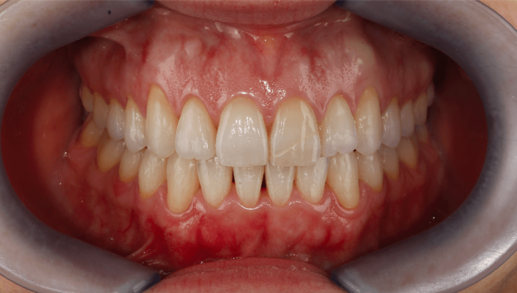 ortodoncia invisible en valencia- Clínica Peydro