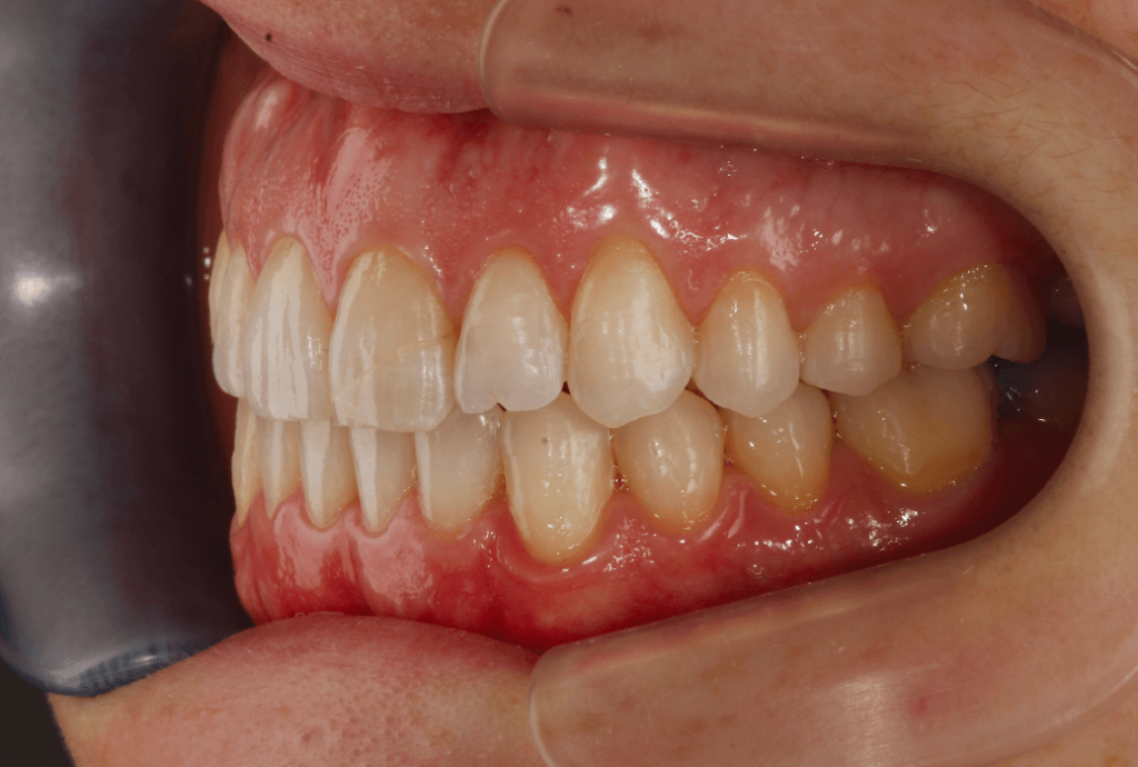 ortodoncia invisible en valencia- Clínica Peydro