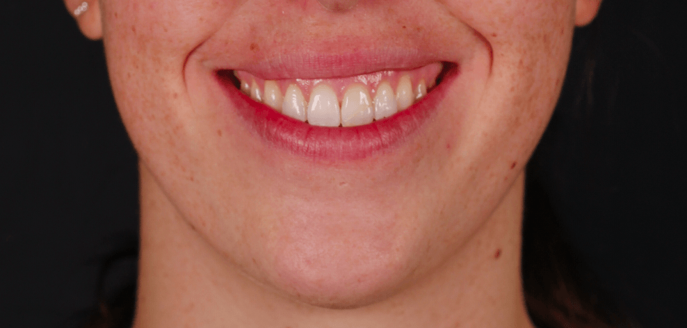 ortodoncia invisible en valencia- Clínica Peydro