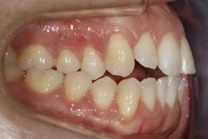 ortodoncia invisible en valencia- Clínica Peydro