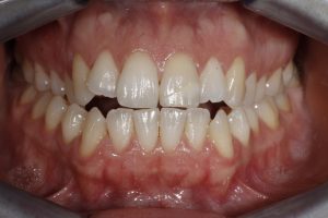 ortodoncia invisible en valencia- Clínica Peydro