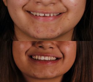 * Fotografía frontal de la pacientes antes y después del tratamiento