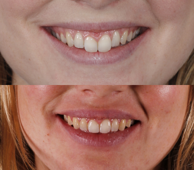 * Fotografía frontal de la paciente antes y después del tratamiento