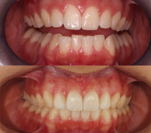 * Fotografía frontal de la paciente del antes y después del tratamiento