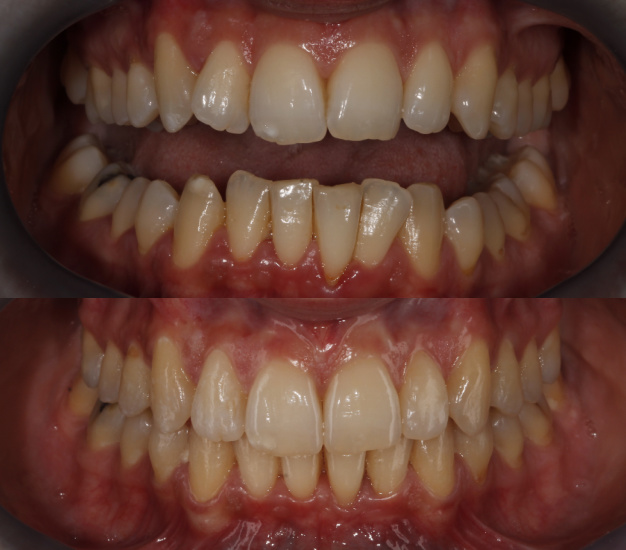 * Fotografía frontal de la paciente antes y después del tratamiento de ortodoncia