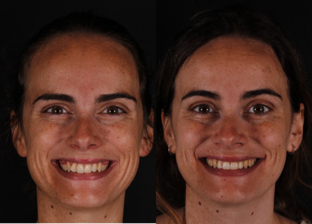 * Fotografía del antes y después de la paciente tras el tratamiento