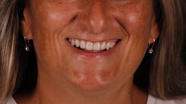 Ortodoncia y blanqueamiento