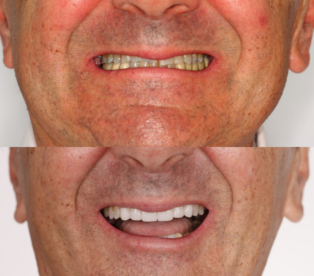 dientes desgastados antes y después