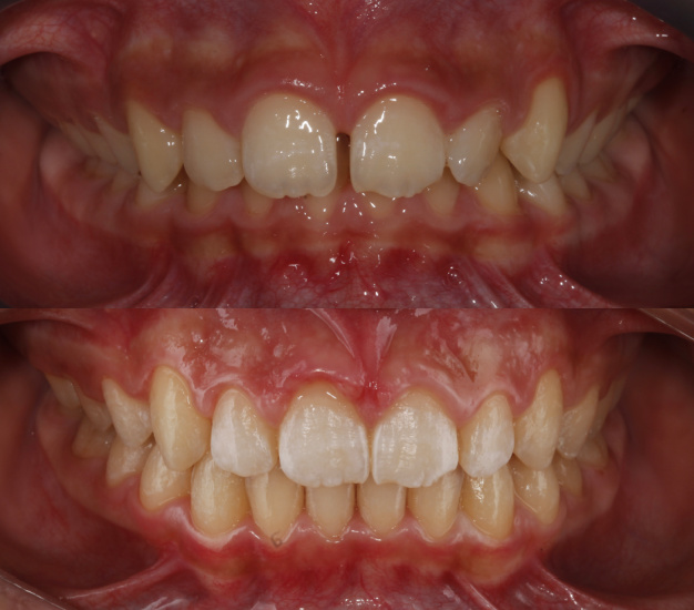 Ortodoncia ivnisible antes y después