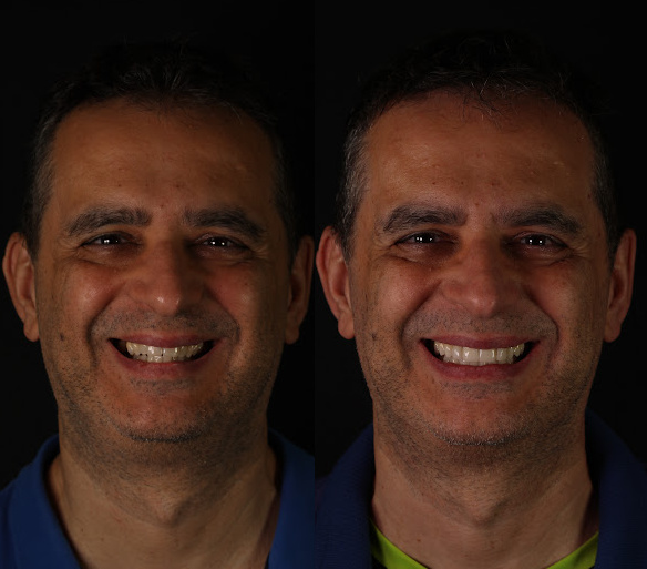 estética dental en Valencia - Clínica Peydro