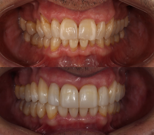 estética dental en Valencia - Clínica Peydro