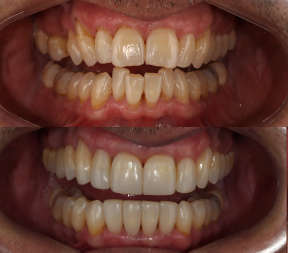 estética dental en Valencia - Clínica Peydro