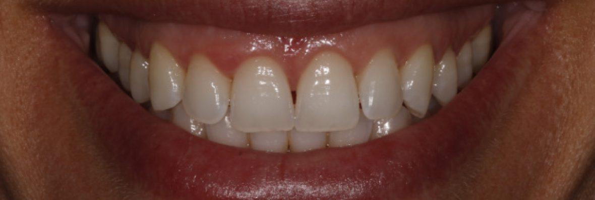Gingivoplastia y blanqueamiento dental