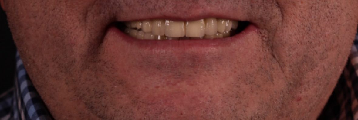 Rehabilitacion de implantes dentales