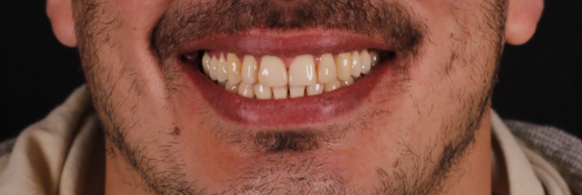 Ortodoncia y carillas en Clínica Peydro