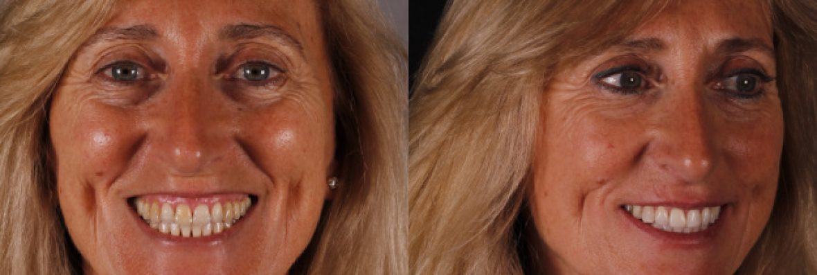 * Fotografía de la paciente antes y después del tratamiento multidisciplinar