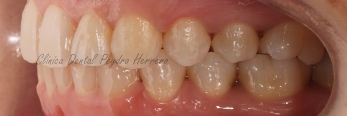 corregir-la-sonrisa-gingival-con-ortodoncia-10