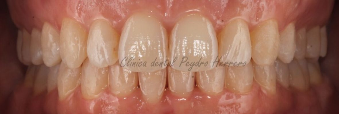 corregir-la-sonrisa-gingival-con-ortodoncia-8