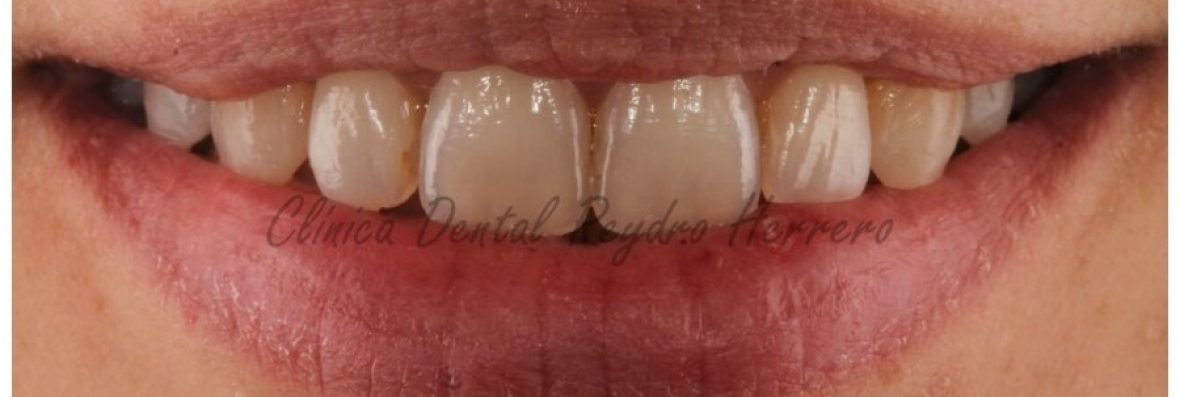 corregir-la-sonrisa-gingival-con-ortodoncia-recortada