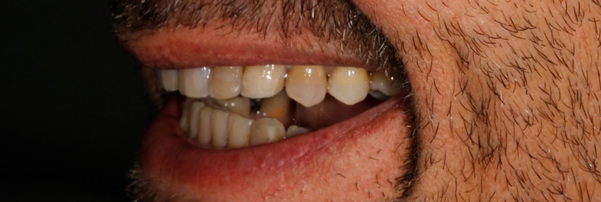 dientes-manchados-por-tetraciclinas-012