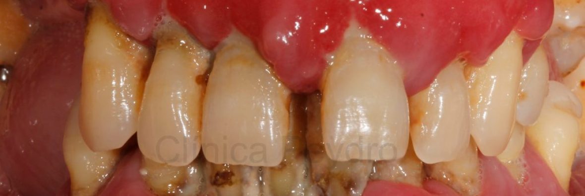 implantes-dentales-01-1024x593