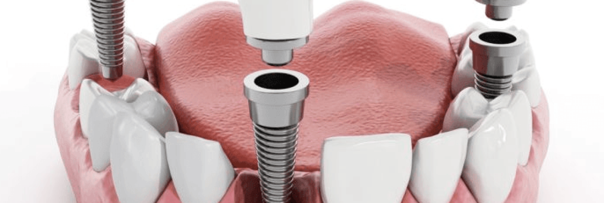 implantes dentales tornillos